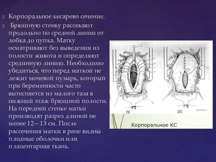 Корпоральное кесарево сечение. Брюшную стенку рассекают продольно по средней линии от лобка