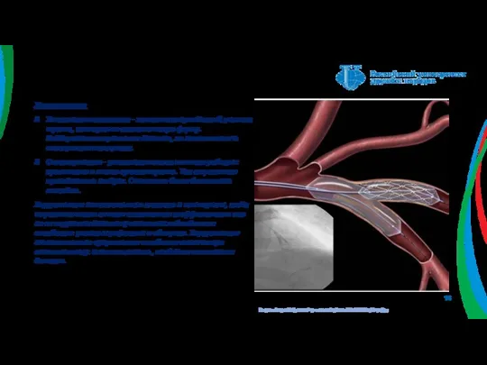 Рисунок https://afgsm.ru/wp-content/uploads/2019/09/faq524pr.jpg Хирургическое Установка имплантата – заменяет поврежденный участок трахеи, повторяя ее