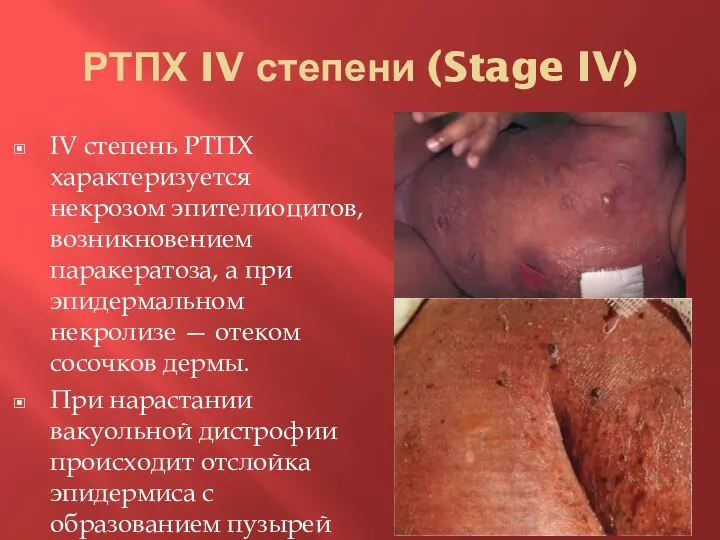 IV степень РТПХ характеризуется некрозом эпителиоцитов, возникновением паракератоза, а при эпидермальном некролизе