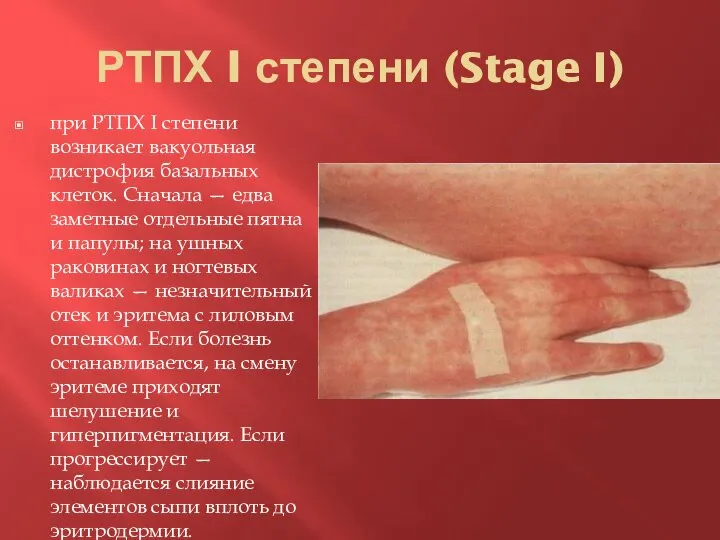 РТПХ I степени (Stage I) при РТПХ I степени возникает вакуольная дистрофия