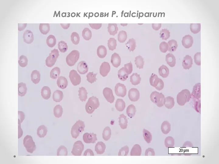 Мазок крови P. falciparum