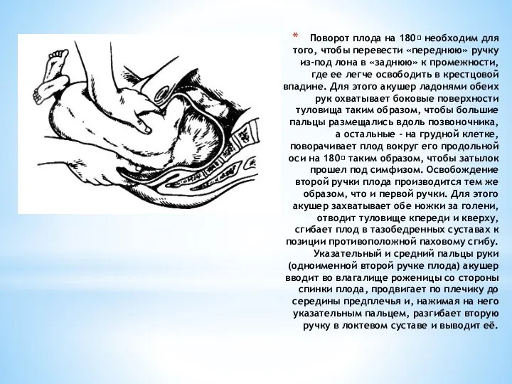 Поворот плода на 180 необходим для того, чтобы перевести «переднюю» ручку из-под