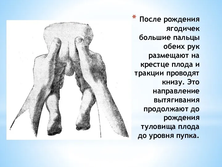 После рождения ягодичек большие пальцы обеих рук размещают на крестце плода и