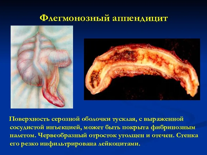 Флегмонозный аппендицит Поверхность серозной оболочки тусклая, с выраженной сосудистой инъекцией, может быть