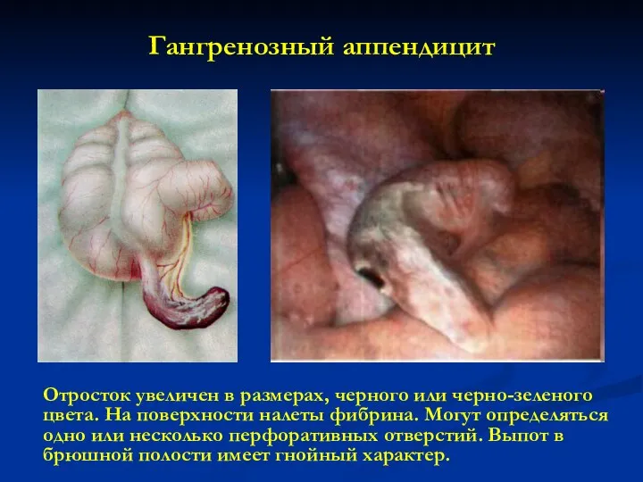 Гангренозный аппендицит Отросток увеличен в размерах, черного или черно-зеленого цвета. На поверхности