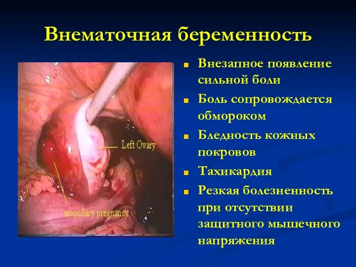 Внематочная беременность Внезапное появление сильной боли Боль сопровождается обмороком Бледность кожных покровов