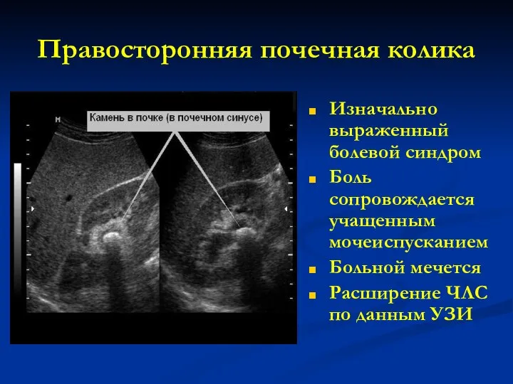 Правосторонняя почечная колика Изначально выраженный болевой синдром Боль сопровождается учащенным мочеиспусканием Больной