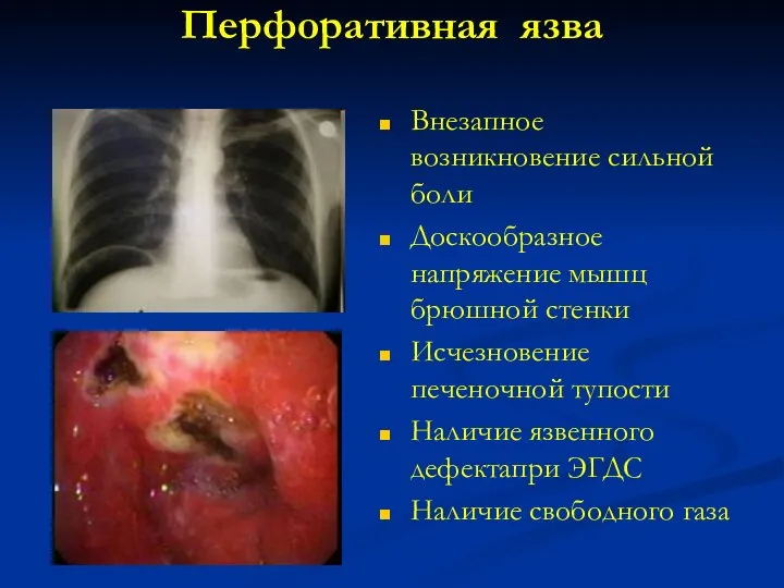 Перфоративная язва Внезапное возникновение сильной боли Доскообразное напряжение мышц брюшной стенки Исчезновение