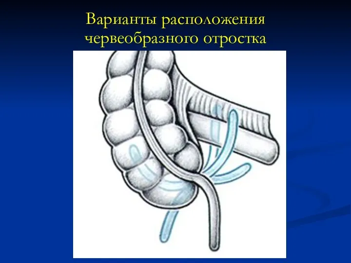 Варианты расположения червеобразного отростка