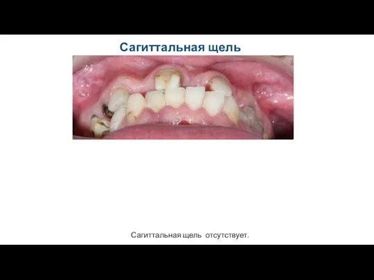 Сагиттальная щель Сагиттальная щель отсутствует.