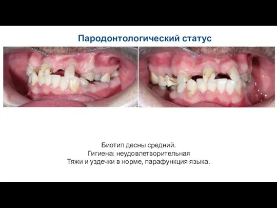 Пародонтологический статус Биотип десны средний. Гигиена: неудовлетворительная Тяжи и уздечки в норме, парафункция языка.