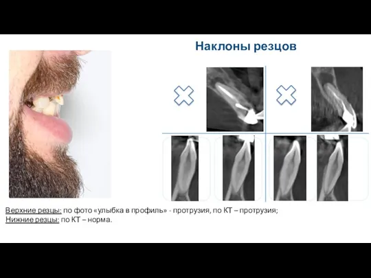 Наклоны резцов Верхние резцы: по фото «улыбка в профиль» - протрузия, по