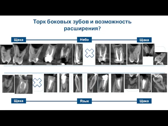 Щека Небо Щека Торк боковых зубов и возможность расширения? Язык Щека Щека