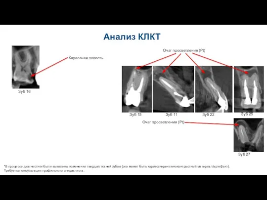Анализ КЛКТ *В процессе диагностики были выявлены изменения твердых тканей зубов (это