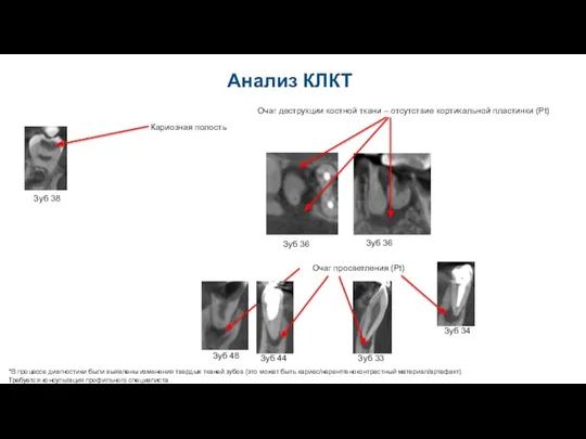 Анализ КЛКТ *В процессе диагностики были выявлены изменения твердых тканей зубов (это