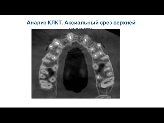 Анализ КЛКТ. Аксиальный срез верхней челюсти.