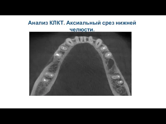 Анализ КЛКТ. Аксиальный срез нижней челюсти.