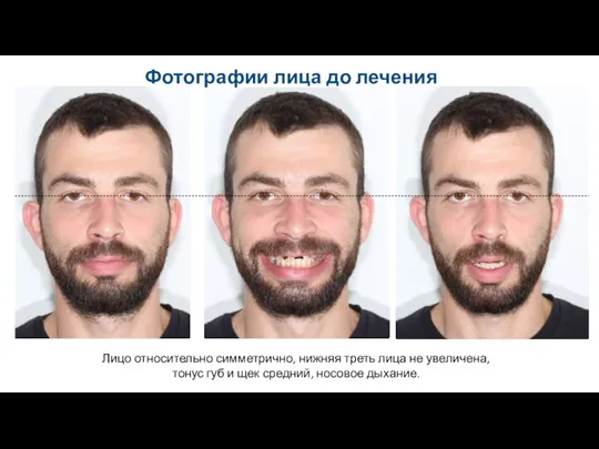 Лицо относительно симметрично, нижняя треть лица не увеличена, тонус губ и щек