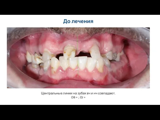Центральные линии на зубах вч и нч совпадают. OB = ; OJ = До лечения