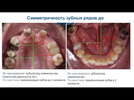 Симметричность зубных рядов до лечения По трансверзали: зубной ряд симметричен. Скелетная ширина