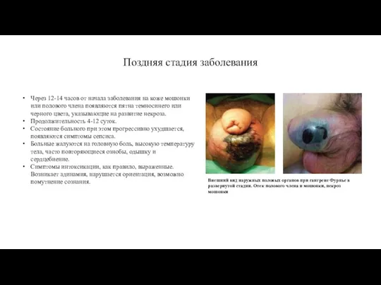 Поздняя стадия заболевания Через 12-14 часов от начала заболевания на коже мошонки