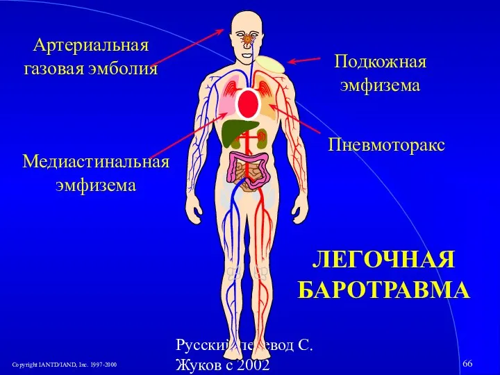 Русский перевод С. Жуков с 2002 Пневмоторакс Артериальная газовая эмболия Медиастинальная эмфизема Подкожная эмфизема ЛЕГОЧНАЯ БАРОТРАВМА