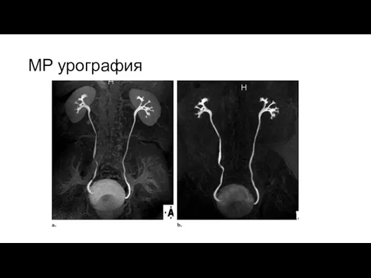 МР урография