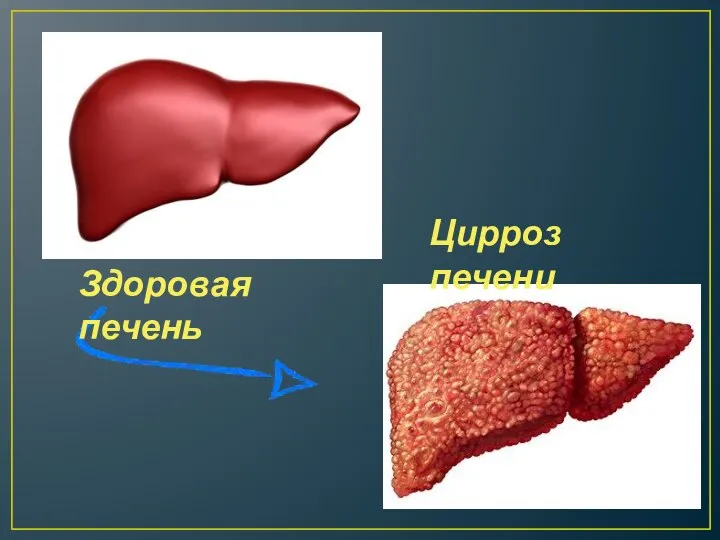 Здоровая печень Цирроз печени