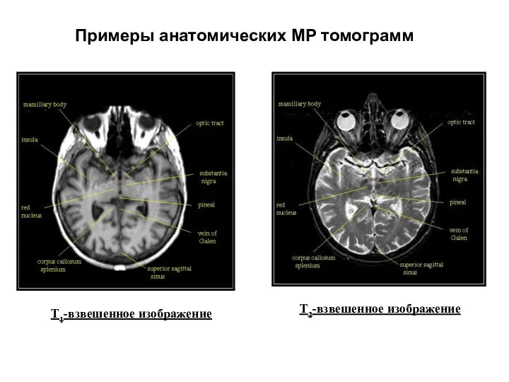 T1-взвешенное изображение T2-взвешенное изображение Примеры анатомических МР томограмм