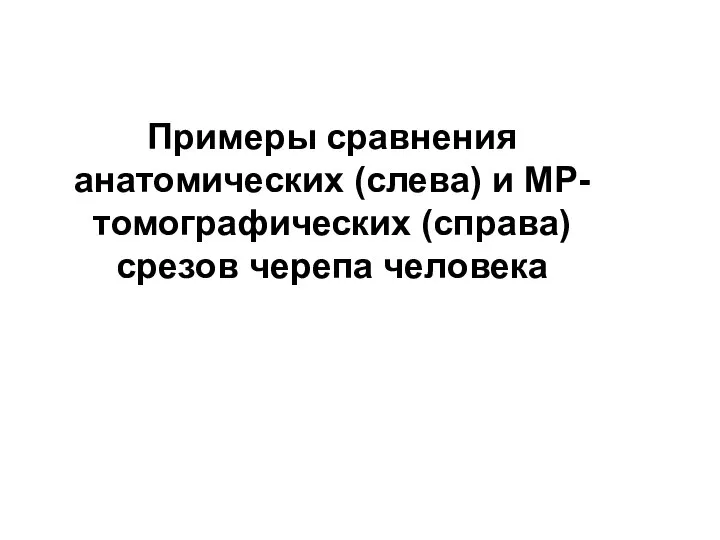 Примеры сравнения анатомических (слева) и МР-томографических (справа) срезов черепа человека