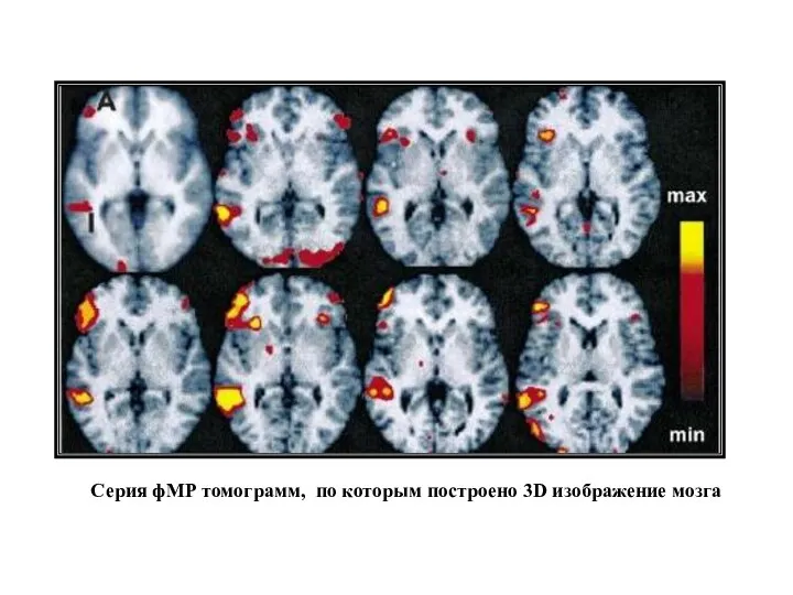 Серия фМР томограмм, по которым построено 3D изображение мозга