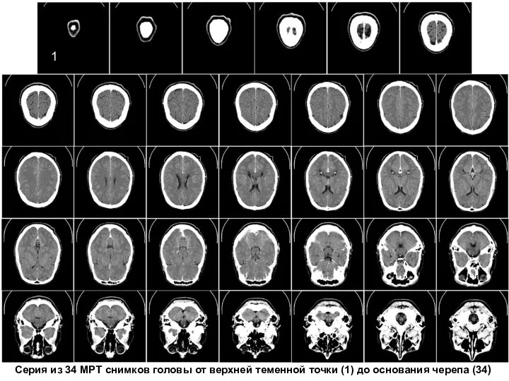 Серия из 34 МРТ снимков головы от верхней теменной точки (1) до основания черепа (34) 1