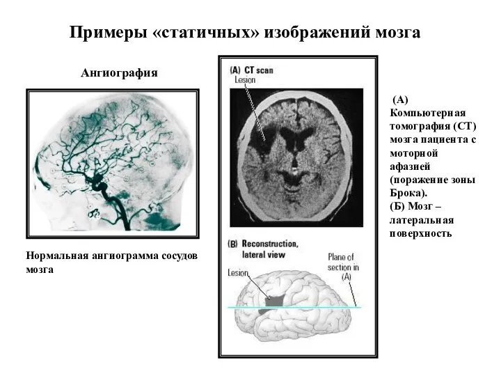 Примеры «статичных» изображений мозга Ангиография Нормальная ангиограмма сосудов мозга (A) Компьютерная томография