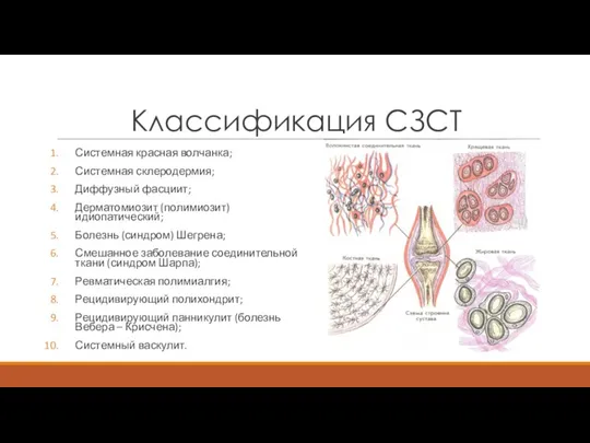 Классификация СЗСТ Системная красная волчанка; Системная склеродермия; Диффузный фасциит; Дерматомиозит (полимиозит) идиопатический;