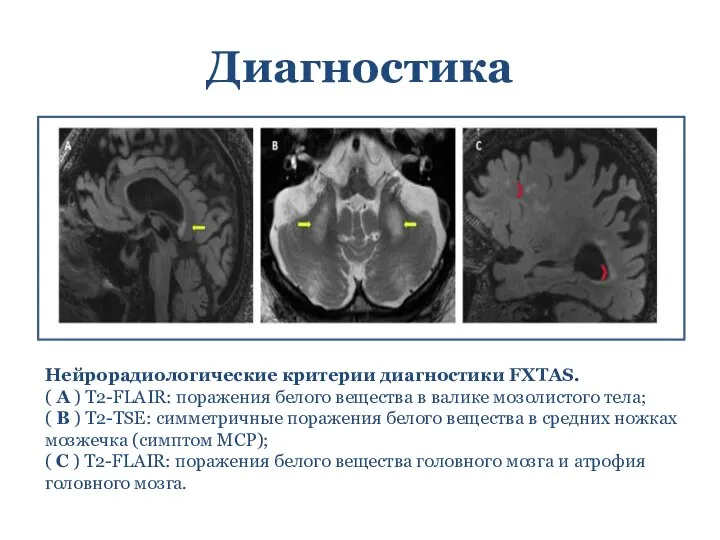 Диагностика Нейрорадиологические критерии диагностики FXTAS. ( A ) T2-FLAIR: поражения белого вещества