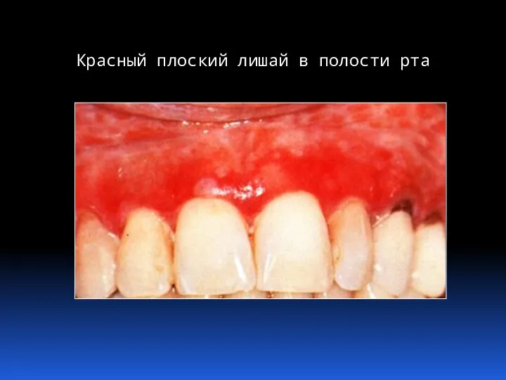 Красный плоский лишай в полости рта