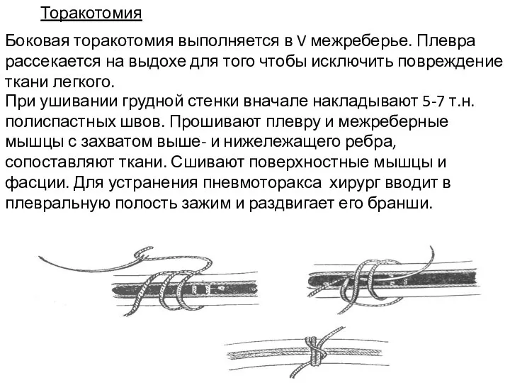 Торакотомия Боковая торакотомия выполняется в V межреберье. Плевра рассекается на выдохе для