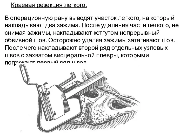 Краевая резекция легкого. В операционную рану выводят участок легкого, на который накладывают