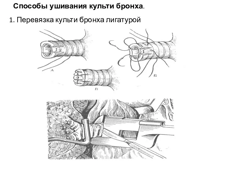 Способы ушивания культи бронха. 1. Перевязка культи бронха лигатурой