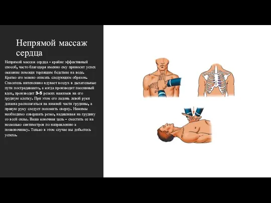 Непрямой массаж сердца Непрямой массаж сердца - крайне эффективный способ, часто благодаря