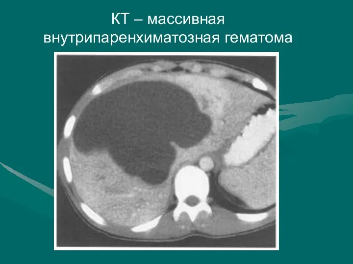 КТ – массивная внутрипаренхиматозная гематома