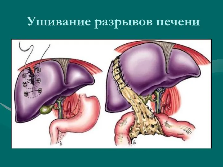 Ушивание разрывов печени