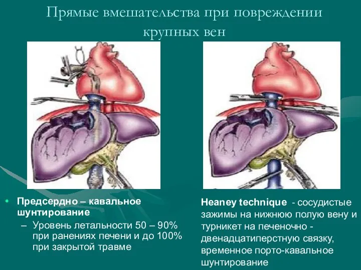 Прямые вмешательства при повреждении крупных вен Предсердно – кавальное шунтирование Уровень летальности