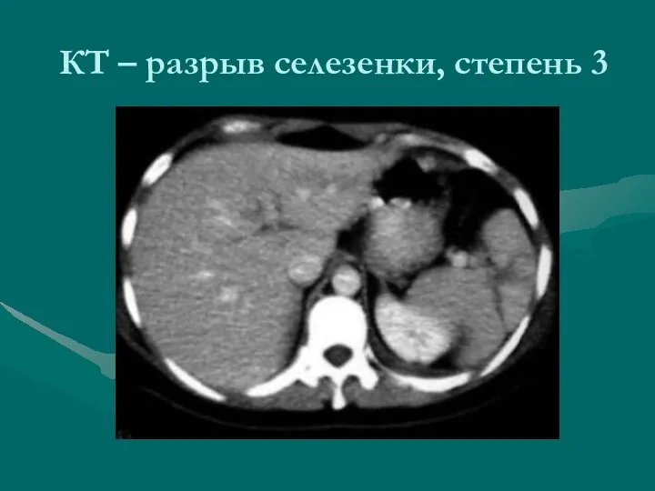 КТ – разрыв селезенки, степень 3