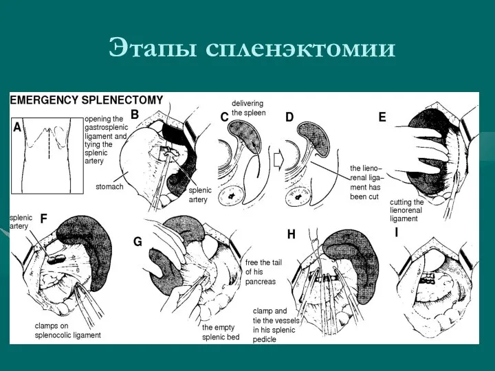 Этапы спленэктомии