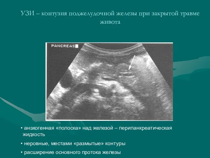 УЗИ – контузия поджелудочной железы при закрытой травме живота анэхогенная «полоска» над