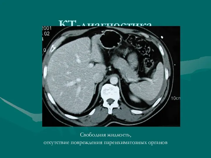 КТ-диагностика Свободная жидкость, отсутствие повреждения паренхиматозных органов