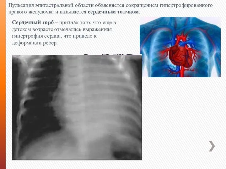 Пульсация эпигастральной области объясняется сокращением гипертрофированного правого желудочка и называется сердечным толчком.