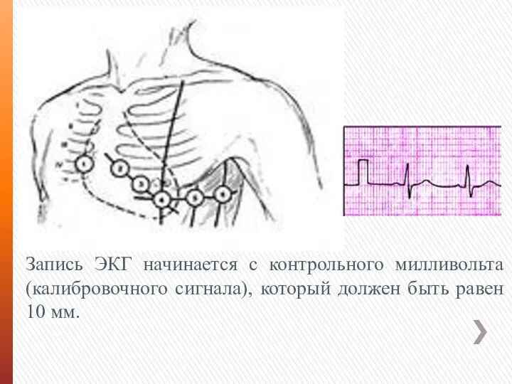 Запись ЭКГ начинается с контрольного милливольта (калибровочного сигнала), который должен быть равен 10 мм.