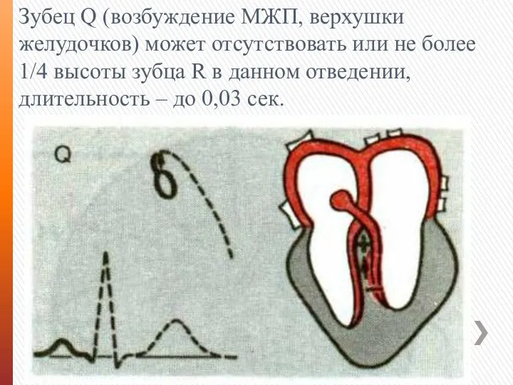 Зубец Q (возбуждение МЖП, верхушки желудочков) может отсутствовать или не более 1/4